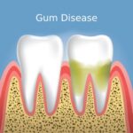 A detailed article discussing the nature of periodontal disease, including its types (gingivitis and periodontitis), the role of bacteria, and whether it is communicable. The text explores transmission pathways through saliva, the impact of dental hygiene, genetic factors, and individual susceptibility. It emphasizes prevention strategies such as maintaining oral hygiene and regular dental visits.