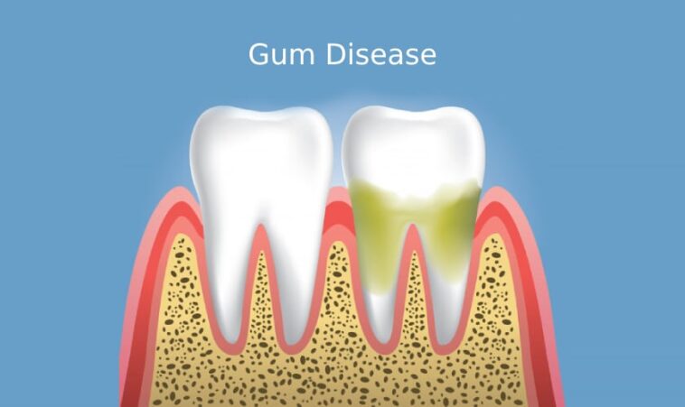 A detailed article discussing the nature of periodontal disease, including its types (gingivitis and periodontitis), the role of bacteria, and whether it is communicable. The text explores transmission pathways through saliva, the impact of dental hygiene, genetic factors, and individual susceptibility. It emphasizes prevention strategies such as maintaining oral hygiene and regular dental visits.